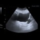 Diverticulum of urinary bladder: US - Ultrasound